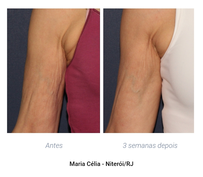 antes e depois axila