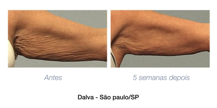 antes e depois braco