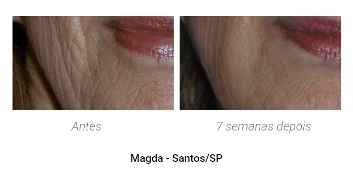 antes e depois labios